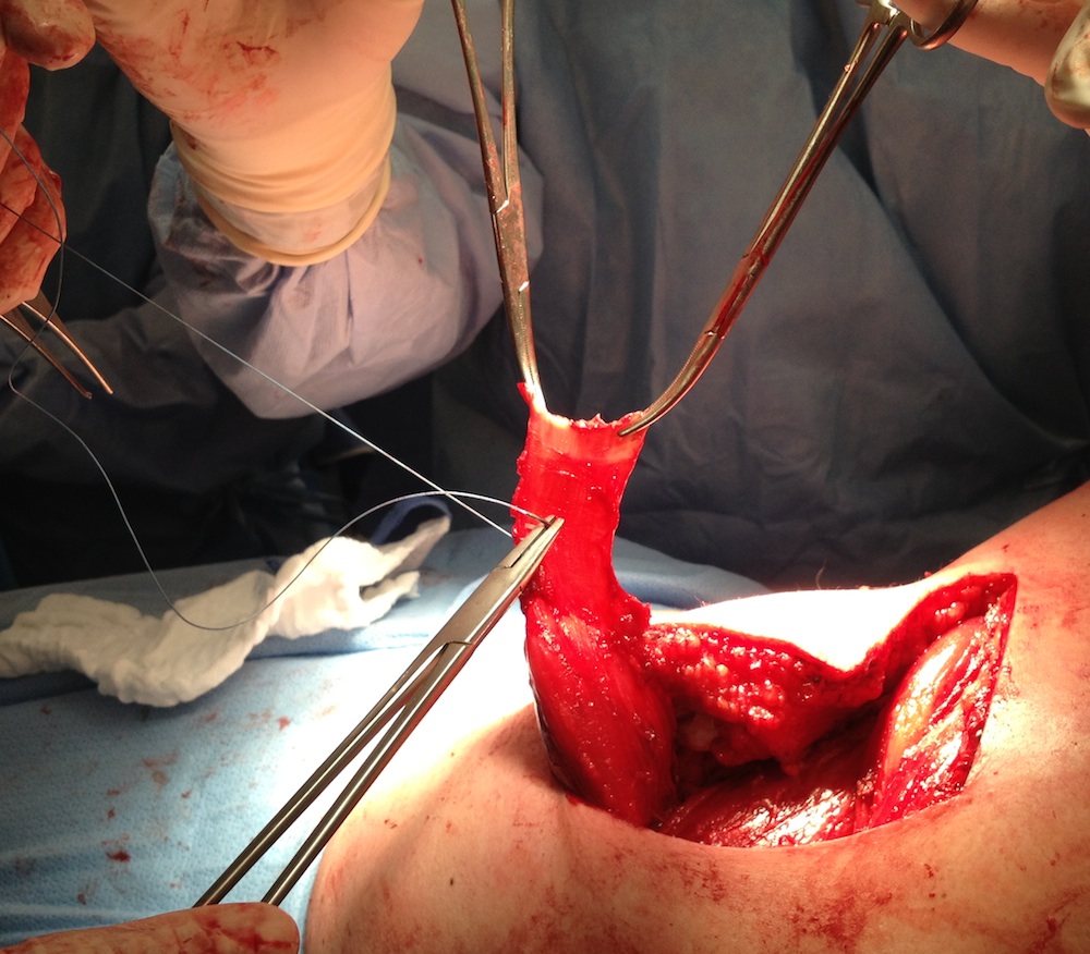 LDTT tendon suture